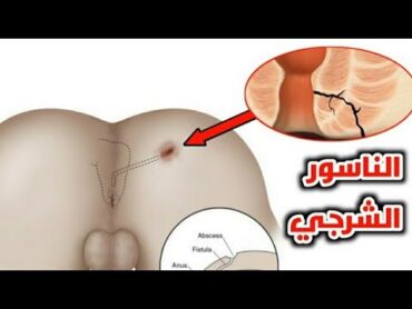 ماهو الناسور الشرجي وكيف يتم علاجة anal fistula